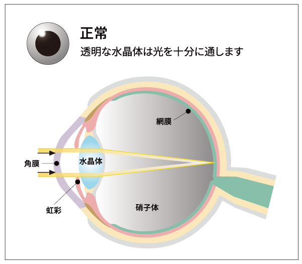 白内障とは