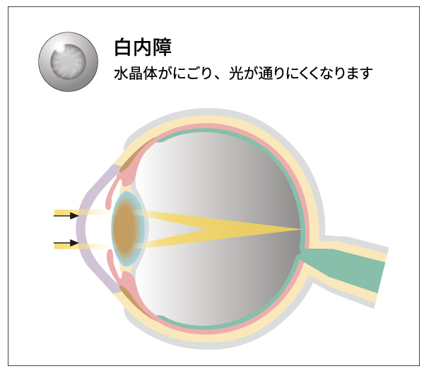 白内障とは